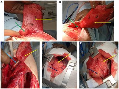 Prevention of bronchial fistulas after pneumonectomies for selected cavitary drug resistant lung tuberculosis
